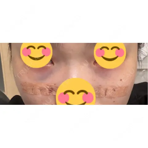 クマ治療 R Beauty CLINIC 大阪院 DAY 0
