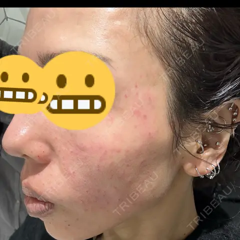マイクロボトックス / 肌育注射（ジュベルックなど） DMTC美容皮膚科 渋谷院 DAY 0