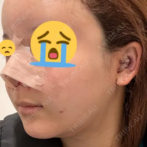 隆鼻術 / 鼻尖形成（切開） / 鼻中隔延長（切開） / 軟骨移植 / 鼻孔縁挙上 / 脂肪注入（額） KIMI CLINIC 形成・美容外科 DAY 0