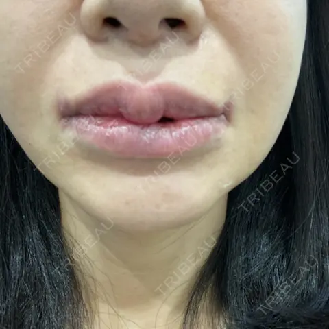 口唇縮小術 / 口角挙上 R Beauty CLINIC 銀座院 DAY 7