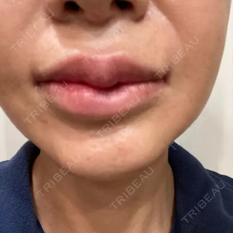 口唇縮小術 / 口角挙上 R Beauty CLINIC 銀座院 AFTER