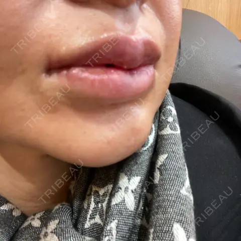 口唇縮小術 / 口角挙上 R Beauty CLINIC 銀座院 AFTER