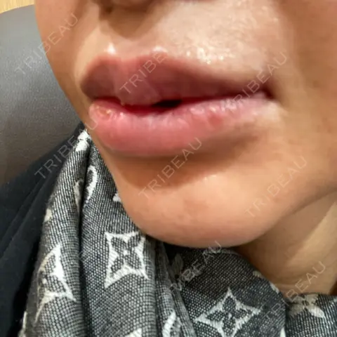 口唇縮小術 / 口角挙上 R Beauty CLINIC 銀座院 AFTER