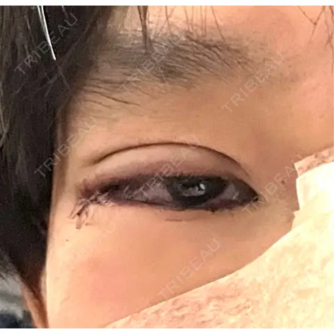 二重埋没 / 鼻尖形成（切開） / 口唇縮小術 / 目尻切開 / タレ目形成・グラマラスライン（切開） / 軟骨移植 / 眉間プロテーゼ アリエル美容クリニック 大宮院 DAY 0