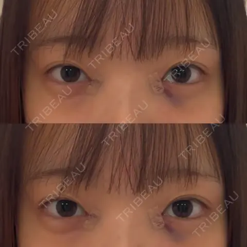 目頭切開 銀座みゆき通り美容外科 大阪梅田院 DAY 0