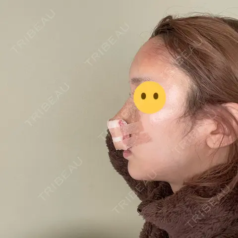 鼻尖形成（切開） / 鼻中隔延長（切開） / 軟骨移植 / 鼻翼基部形成（貴族手術） 4Dクリニック DAY 1