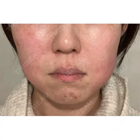 RF（高周波）たるみ治療 RIVER CLINIC（リバークリニック） DAY 0