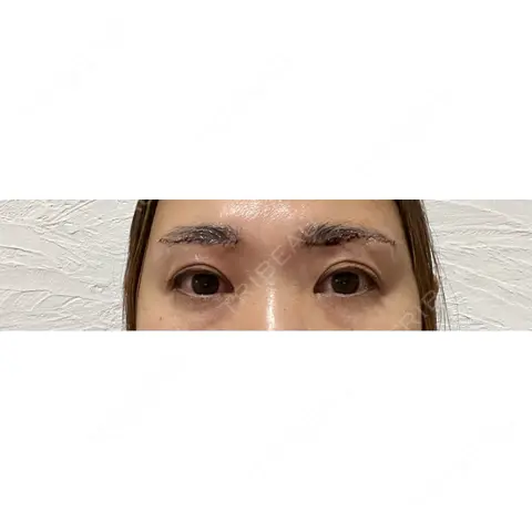 眉下切開 / ボトックス（眉間） / ボトックス（目尻） PRO CLINIC プロクリニック 銀座院 DAY 0