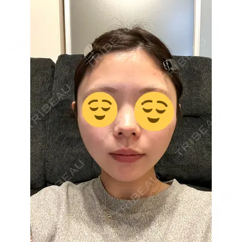 RF（高周波）たるみ治療 共立美容 池袋院 AFTER