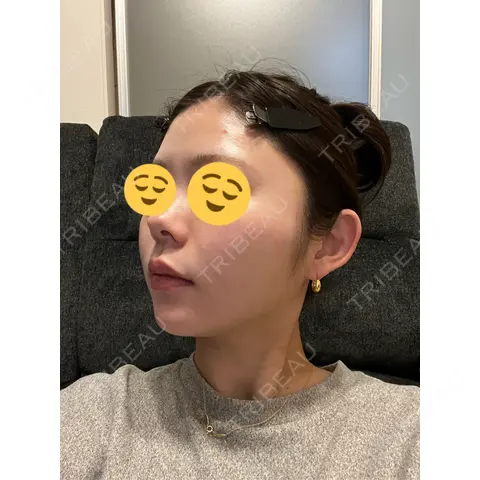 RF（高周波）たるみ治療 共立美容 池袋院 AFTER