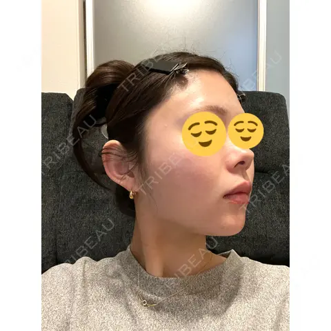 RF（高周波）たるみ治療 共立美容 池袋院 AFTER