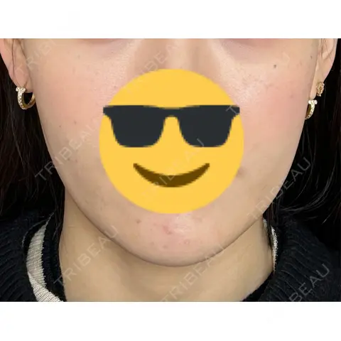 糸リフト 仙台N美容クリニック AFTER