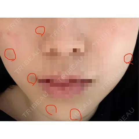 ほくろ・いぼ切除（肌） KARIS beauty clinic AFTER