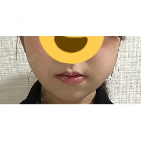 糸リフト / バッカルファット除去 / 脂肪吸引（顔） 湘南美容クリニック 銀座院 AFTER