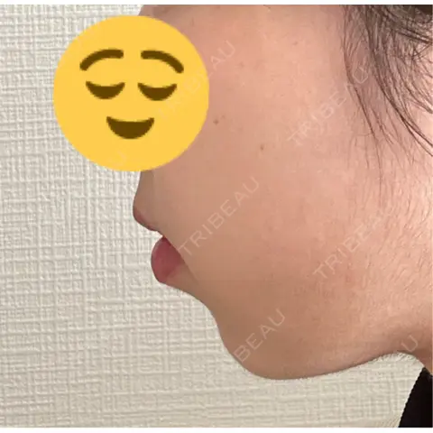 糸リフト / バッカルファット除去 / 脂肪吸引（顔） 湘南美容クリニック 銀座院 AFTER