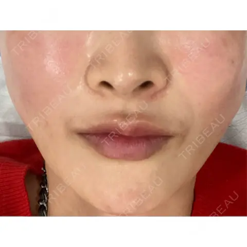 糸リフト / ヒアルロン酸注入（鼻翼基部） / リジュラン Brandnew Beauty Clinic DAY 0