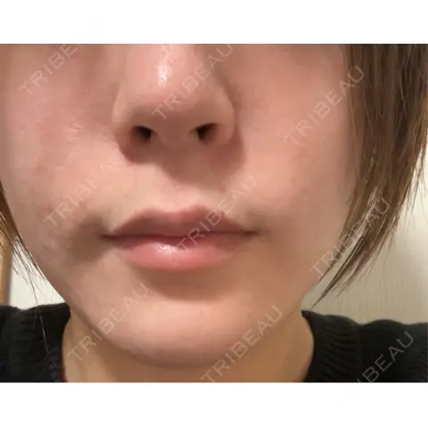 ボトックス（あご） / ボトックス（口角） MAクリニック 心斎橋 AFTER