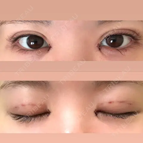 二重埋没 / 目頭切開 / 自然癒着法 Brandnew Beauty Clinic DAY 0