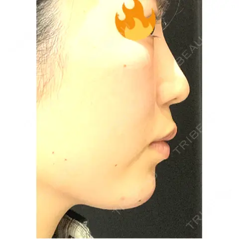 軟骨移植 / 鼻尖形成（非切開） / 鼻柱下降・鼻唇角形成（猫手術） / ヒアルロン酸注入（あご） / その他（鼻） グローバルビューティークリニック 東京院 AFTER