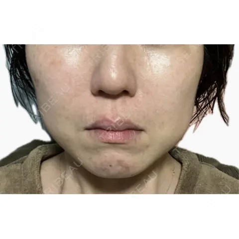 RF（高周波）たるみ治療 RIVER CLINIC（リバークリニック） AFTER