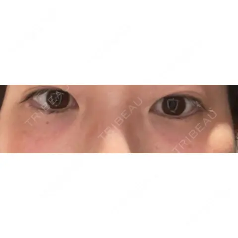 クマ治療 / その他（目元） S Beauty Clinic DAY 0