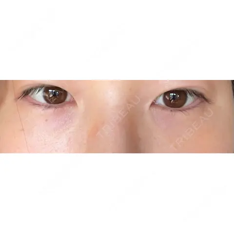 クマ治療 / その他（目元） S Beauty Clinic AFTER