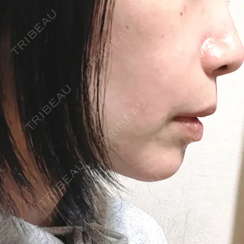 肌ヒアルロン酸注入（たるみ・シワ改善） TCB東京中央美容外科 山形院 AFTER