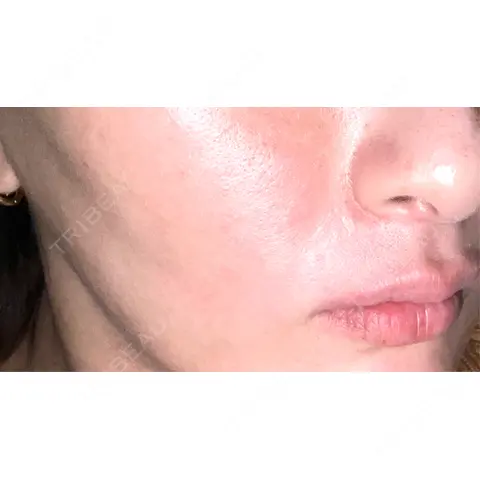 肌ヒアルロン酸注入（たるみ・シワ改善） / ボトックス（口角） / ボトックス（額） メディカルアルファクリニック AFTER