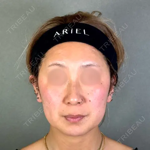 糸リフト / 脂肪吸引（顔） / ジョールファット除去 アリエル美容クリニック 郡山院 DAY 0