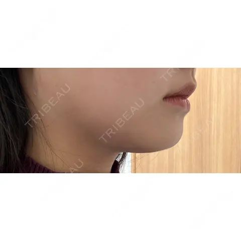 脂肪吸引（顔） / 脂肪吸引注射（顔） ziz CLINIC DAY 0