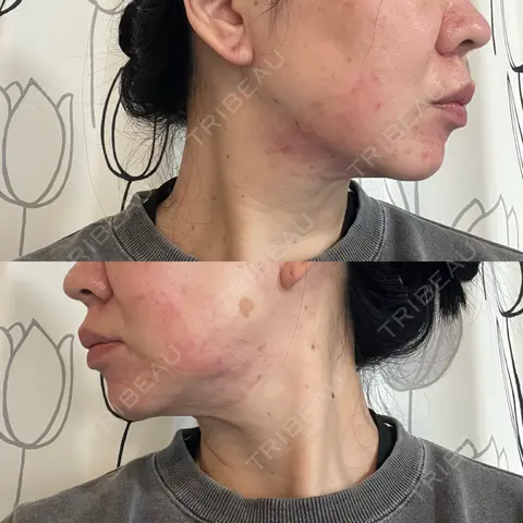 RF（高周波）たるみ治療 RIVER CLINIC（リバークリニック） DAY 0