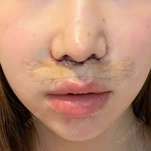 人中短縮 聖心美容クリニック 六本木院 DAY 0