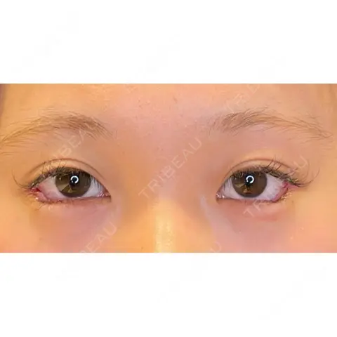 目尻切開 / タレ目形成・グラマラスライン（埋没） LOUIS CLINIC 二子玉川院【ルイクリニック】 DAY 0
