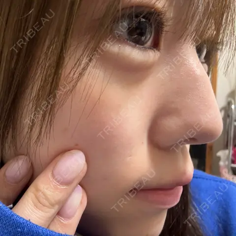 ヒアルロン酸注入（涙袋） / ヒアルロン酸注入（唇） HELLATH CLINIC 新宿院 AFTER