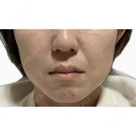RF（高周波）たるみ治療 RIVER CLINIC（リバークリニック） AFTER