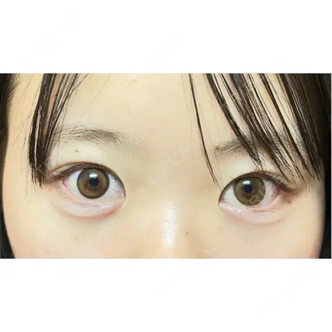 ヒアルロン酸注入（涙袋） AYANAフィラーズクリニック 渋谷院 DAY 0