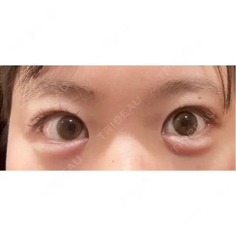 ヒアルロン酸注入（涙袋） AYANAフィラーズクリニック 渋谷院 AFTER