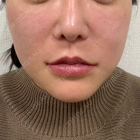 RF（高周波）たるみ治療 共立美容 池袋院 DAY 0
