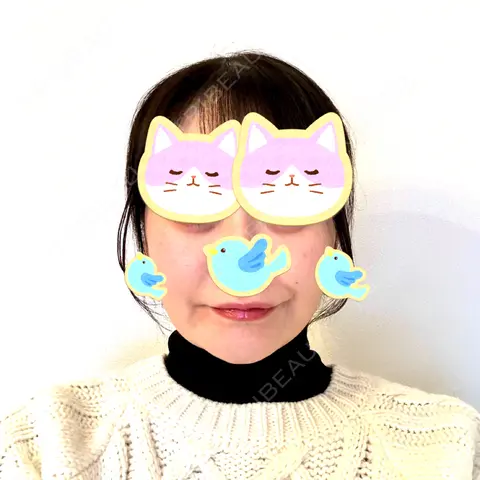 糸リフト / クマ治療 / 脂肪吸引（顔） / 脂肪注入（目の下） / ヒアルロン酸注入（涙袋） / ヒアルロン酸注入（唇） 東京シンデレラ美容外科 池袋院 AFTER