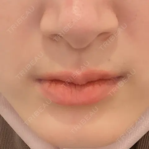 ボトックス（あご） / ボトックス（口角） / シワ取りボトックス / ボトックス（人中） / ボトックス（ガミースマイル） LE CLINIC DAY 0
