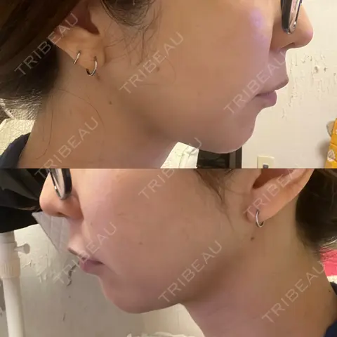 糸リフト / 脂肪吸引（顔） RIVER CLINIC（リバークリニック） AFTER