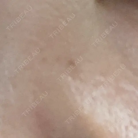 ほくろ・いぼ切除（肌） TCB東京中央美容外科 町田院 AFTER
