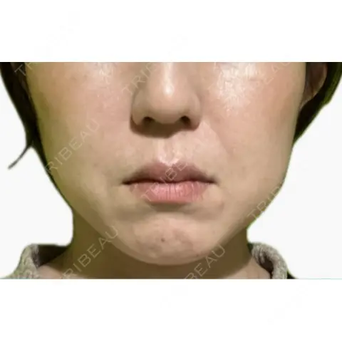 RF（高周波）たるみ治療 RIVER CLINIC（リバークリニック） AFTER