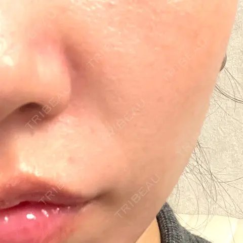 ボトックス（あご） / ボトックス（口角） / ボトックス（額） BiBiクリニック DAY 0