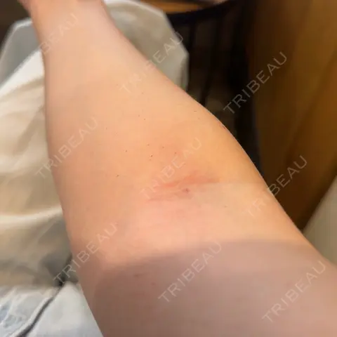 高濃度ビタミンC点滴 HELLATH CLINIC 新宿院 DAY 0
