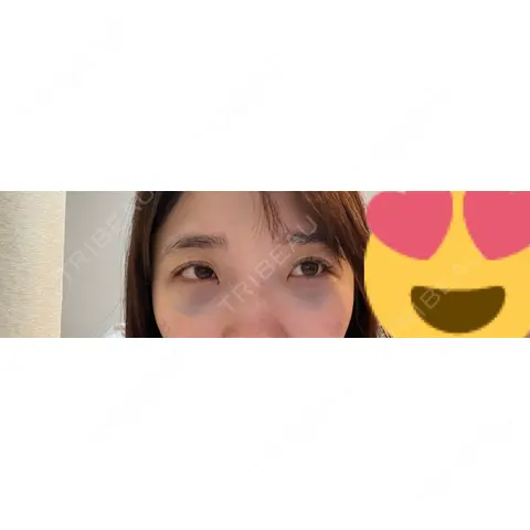 クマ治療 / 下まぶたの脂肪取り / 脂肪注入（目の下） 藤・ナチュレ美容クリニック 銀座院 DAY 0