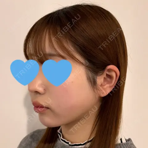 糸リフト / 脂肪吸引（顔） / 脂肪吸引注射（顔） SEA CLINIC（シークリニック） AFTER