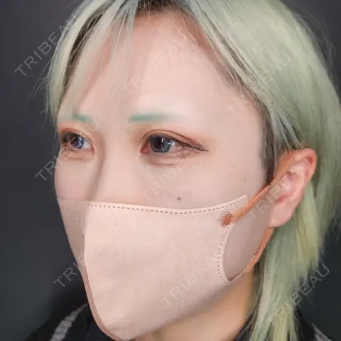 クマ治療 / ヒアルロン酸注入（目の下） / スネコス Tokyo Tensei Clinic 新宿院 AFTER