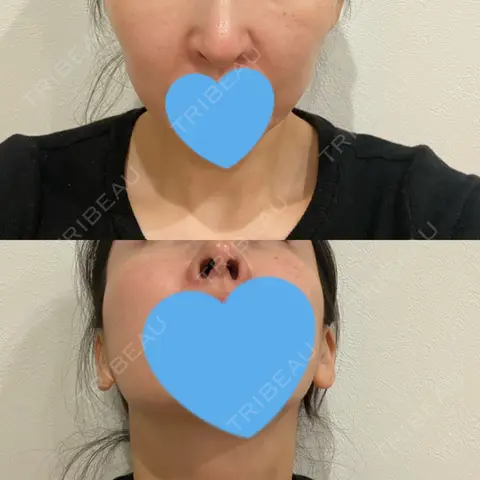 鼻尖形成（切開） / 鼻中隔延長（切開） / 糸リフト / 鼻修正 / 鼻孔縁下降 / ヒアルロン酸注入（鼻翼基部） LOCHIC CLINIC GINZA【ロシッククリニック銀座】 AFTER