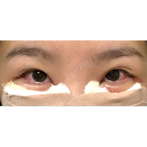 クマ治療 WOM CLINIC GINZA （ワム クリニック ギンザ） DAY 1